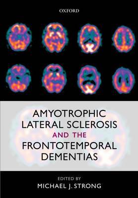 Amyotrophic Lateral Sclerosis and the Frontotemporal Dementias - Click Image to Close