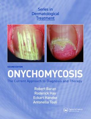 Onychomycosis - Click Image to Close