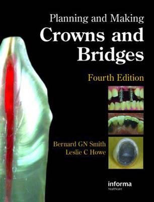 Planning and Making Crowns and Bridges - Click Image to Close
