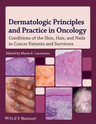 Dermatologic Principles and Practice in Oncology: Conditions of the Skin, Hair, and Nails in Cancer Patients - Click Image to Close