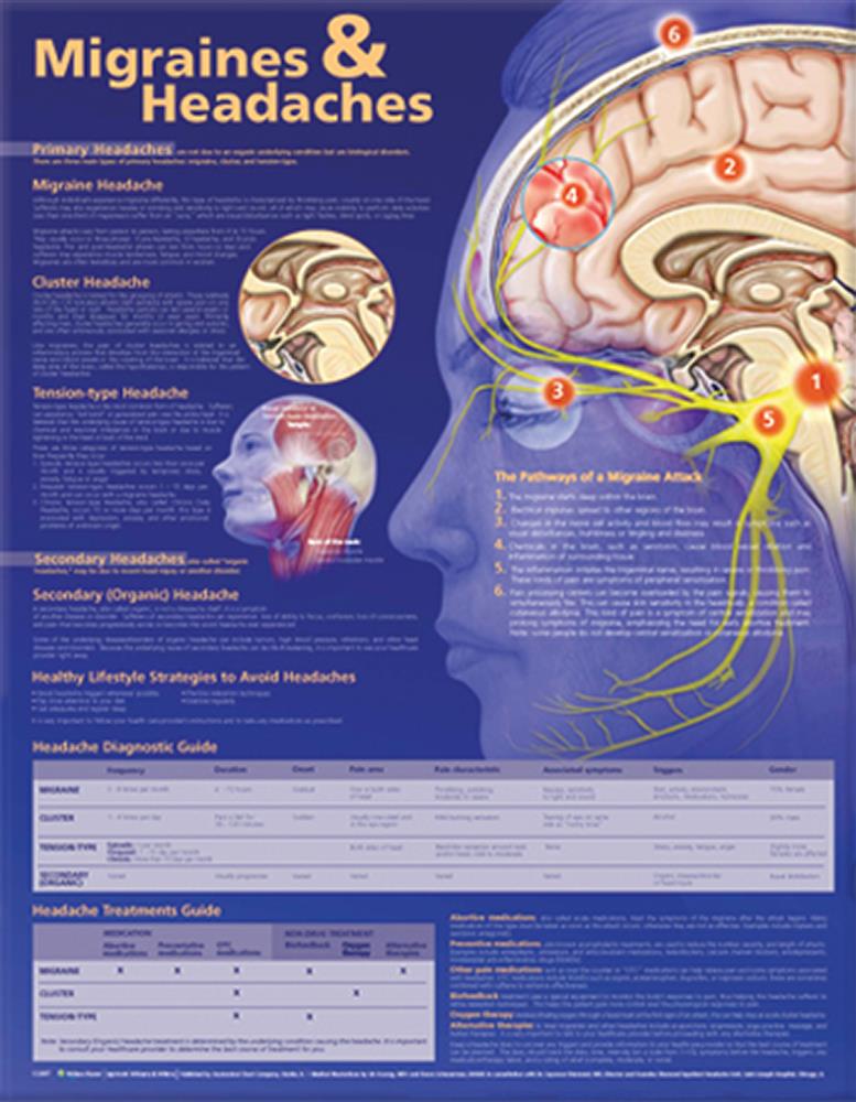 Migraines and Headaches Anatomical Chart - Click Image to Close