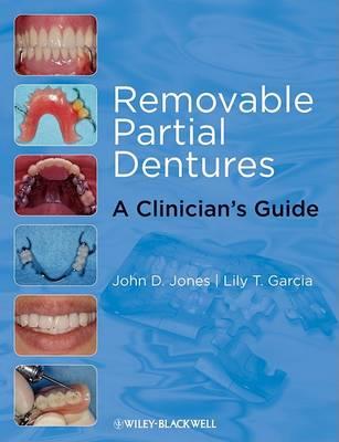 Removable Partial Dentures: A Clinician's Guide - Click Image to Close