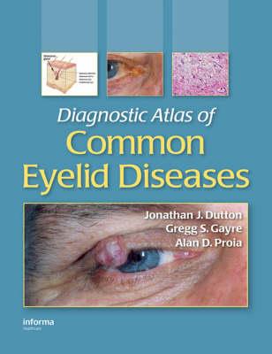 Diagnostic Atlas of Common Eyelid Diseases - Click Image to Close