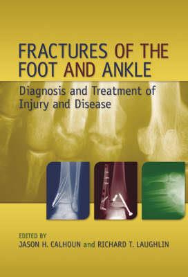 Fractures of the Foot and Ankle - Click Image to Close