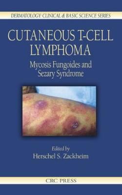 Cutaneous T-Cell Lymphoma - Click Image to Close