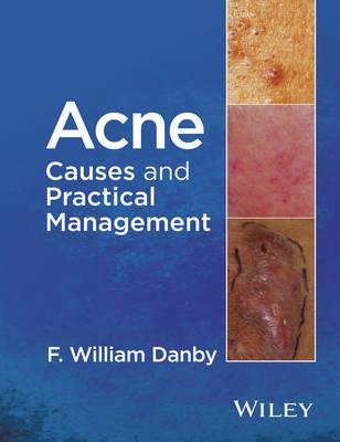 Acne - Causes and Practical Management - Click Image to Close
