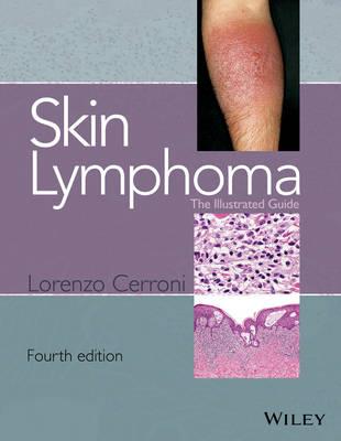 Skin Lymphoma: The Illustrated Guide - Click Image to Close