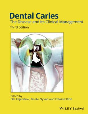 Dental Caries: The Disease and its Clinical Management - Click Image to Close