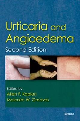 Urticaria and Angioedema - Click Image to Close