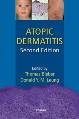 Atopic Dermatitis - Click Image to Close