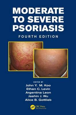 Moderate to Severe Psoriasis - Click Image to Close