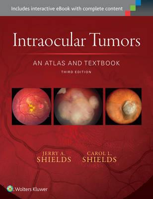 Intraocular Tumors: An Atlas and Textbook - Click Image to Close