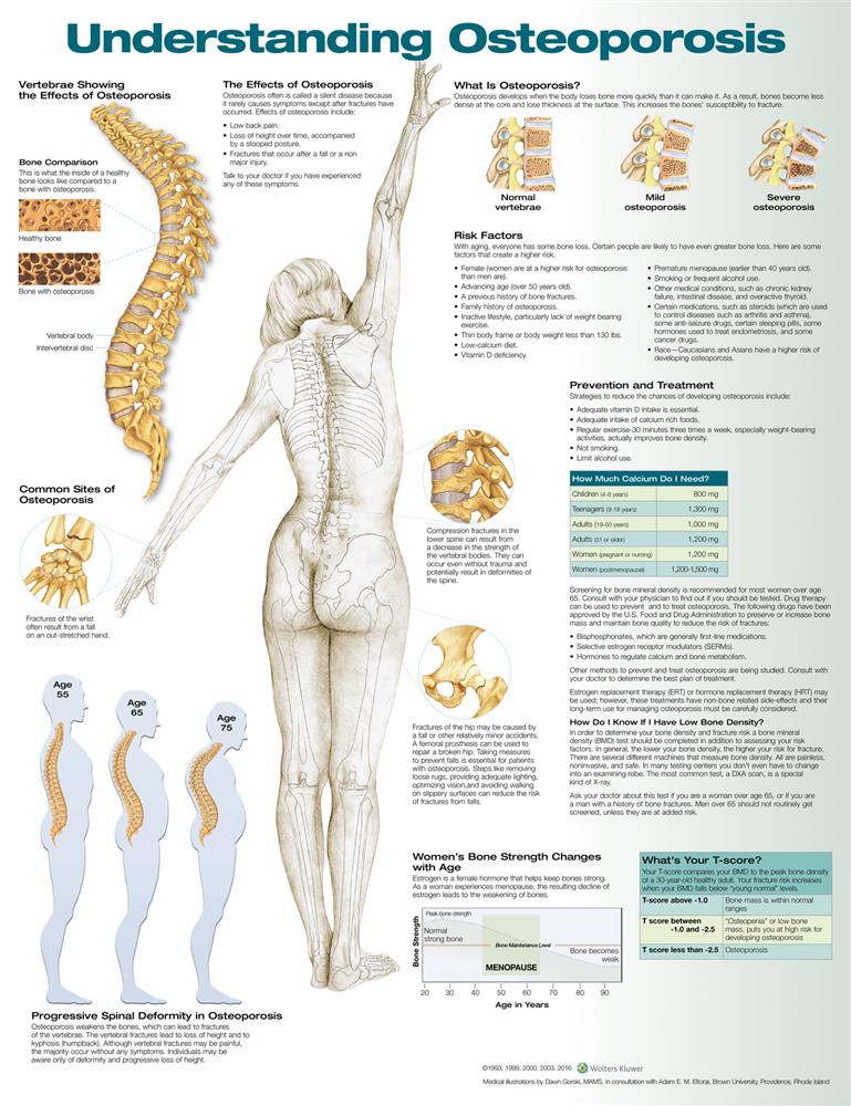 Understanding Osteoporosis - Click Image to Close