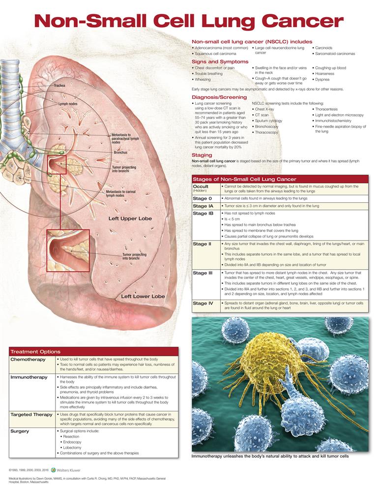 Non-Small Cell Lung Cancer - Click Image to Close