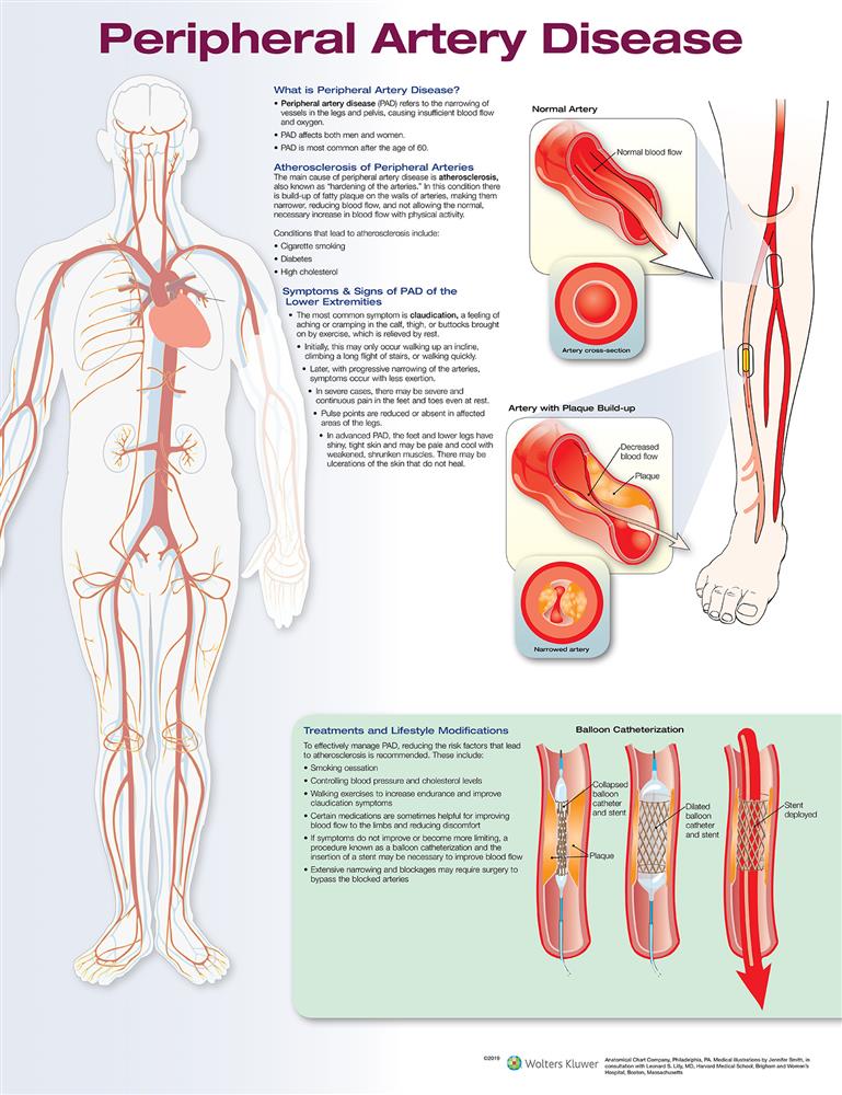 Peripheral Artery Disease - Click Image to Close