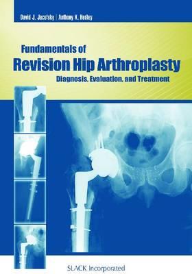 Fundamentals of Revision Hip Arthroplasty - Click Image to Close