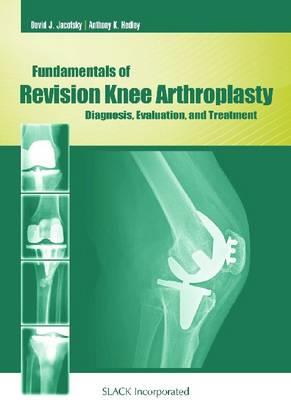 Fundamentals of Revision Knee Arthroplasty - Click Image to Close