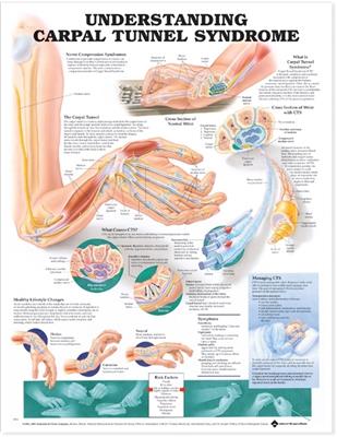 Understanding Carpal Tunnel Syndrome Anatomical Chart - Click Image to Close
