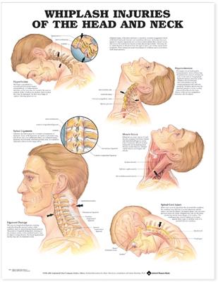 Whiplash Injuries of the Head and Neck Anatomical Chart - Click Image to Close