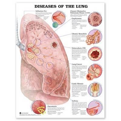 Diseases of the Lung Anatomical Chart - Click Image to Close