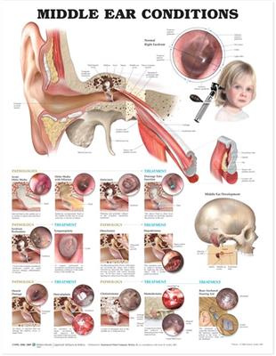 Middle Ear Conditions Anatomical Chart - Click Image to Close