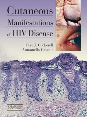 Cutaneous Manifestations of HIV Disease - Click Image to Close