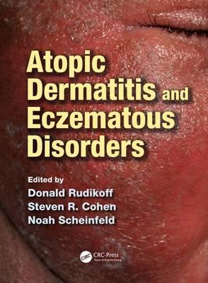 Atopic Dermatitis and Eczematous Disorders - Click Image to Close