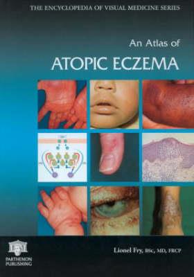 An Atlas of Atopic Eczema - Click Image to Close