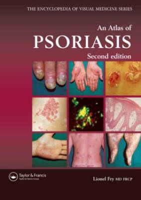 An Atlas of Psoriasis, Second Edition - Click Image to Close