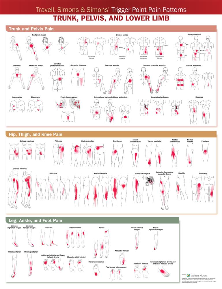 Travell, Simons amp; Simons? Trigger Point Pain Patterns Wall Chart - Click Image to Close