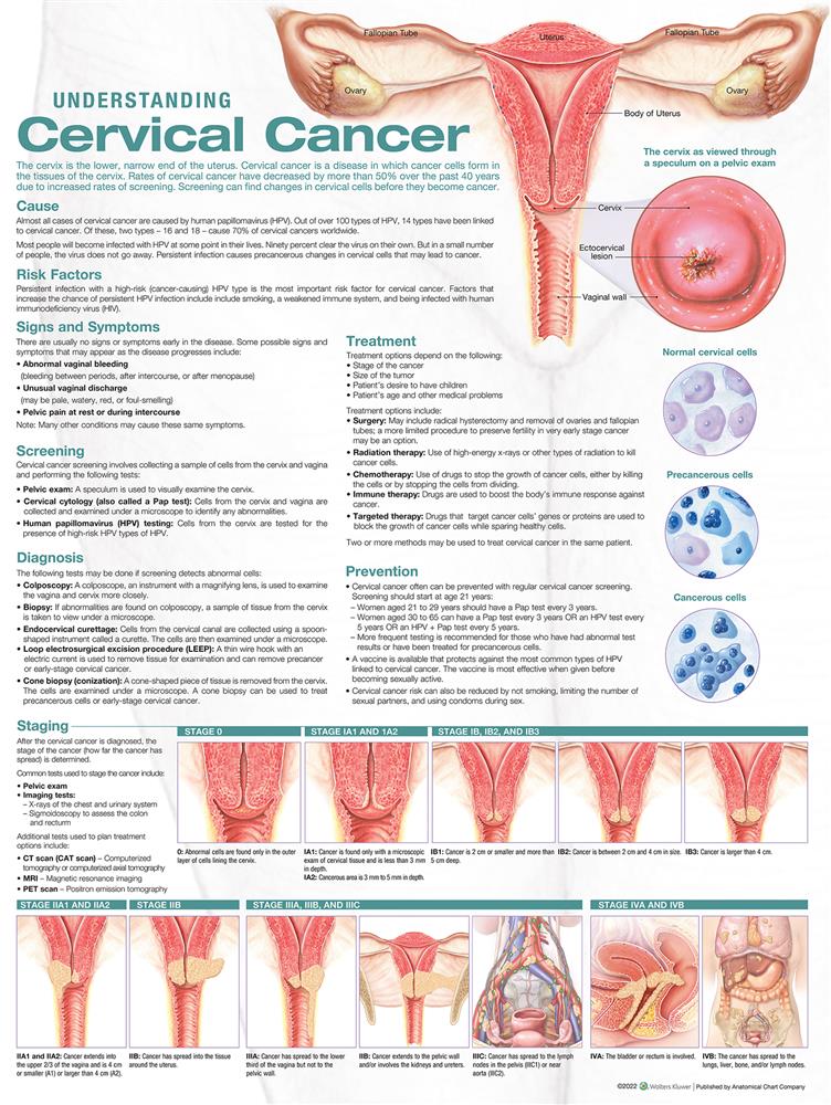 Understanding Cervical Cancer Anatomical Chart - Click Image to Close