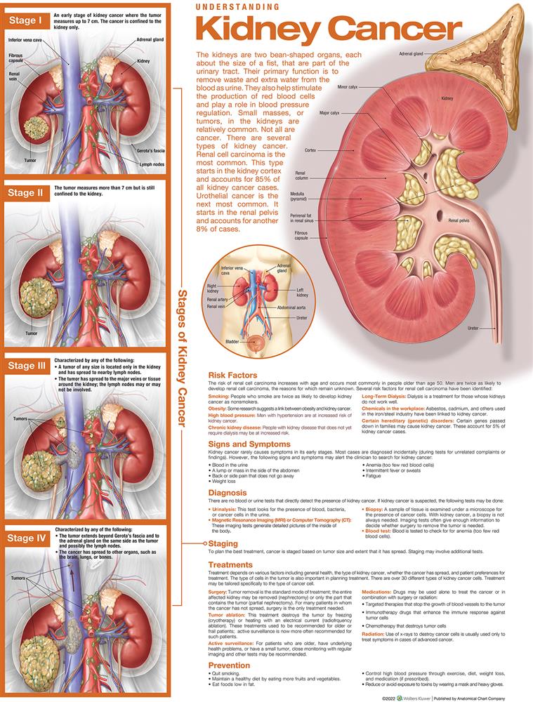 Understanding Kidney Cancer Anatomical Chart - Click Image to Close