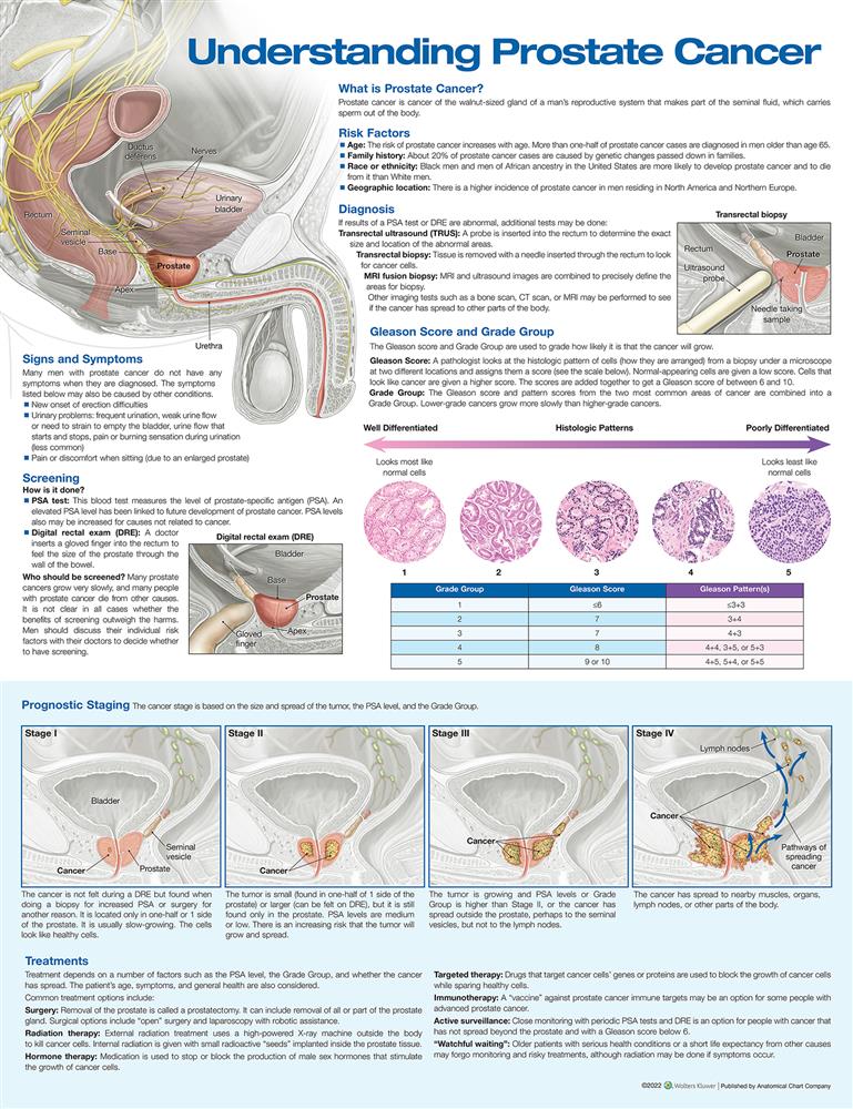 Understanding Prostate Cancer Anatomical Chart - Click Image to Close