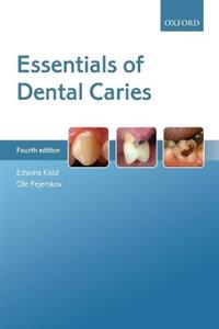 Essentials of Dental Caries - Click Image to Close