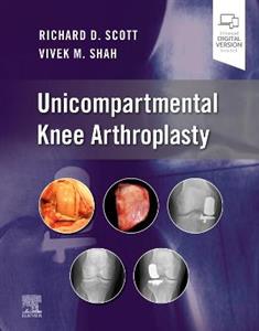 Unicompartmental Knee Arthroplasty