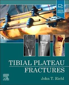 Tibial Plateau Fractures - Click Image to Close