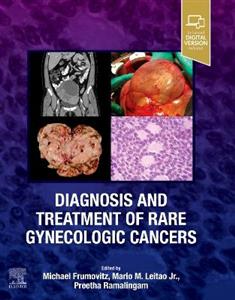 Diagnosis and Treatment of Rare Gynecologic Cancers - Click Image to Close