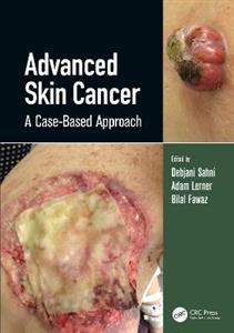 Advanced Skin Cancer - Click Image to Close
