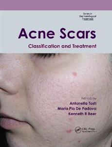Acne Scars - Click Image to Close