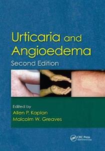 Urticaria and Angioedema - Click Image to Close