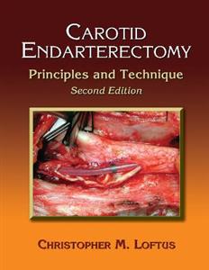 Carotid Endarterectomy - Click Image to Close