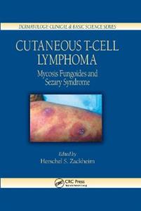 Cutaneous T-Cell Lymphoma - Click Image to Close