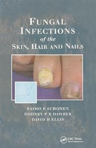 Fungal Infections of the Skin and Nails - Click Image to Close