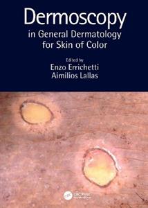 Dermoscopy in General Dermatology for Skin of Color - Click Image to Close