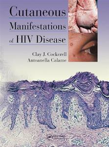 Cutaneous Manifestations of HIV Disease - Click Image to Close