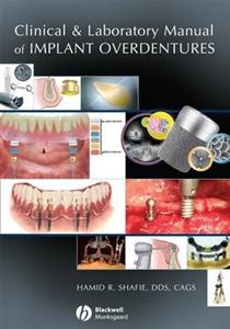 Clinical and Laboratory Manual of Implant Overdentures