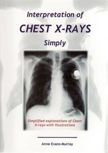 Interpretation of Chest X-Rays Simply