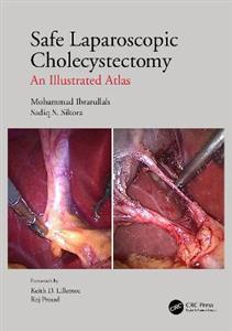 Safe Laparoscopic Cholecystectomy - Click Image to Close