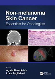 Non-melanoma Skin Cancer: Essentials for Oncologists - Click Image to Close
