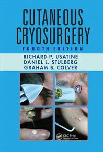 Cutaneous Cryosurgery - Click Image to Close